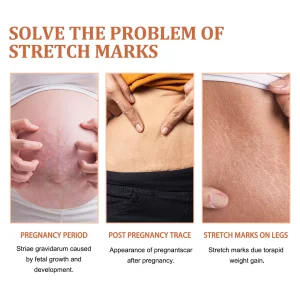 Stretch Mark Cream