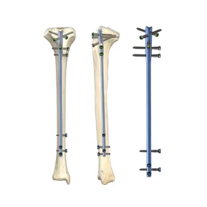 Tibia Intramedullary Nail Reamed and Unreamed Titanium Alloy CE Certified Tibial Nailing System for Adult Trauma