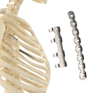 CANWELL Titanium Rib Locking Plate