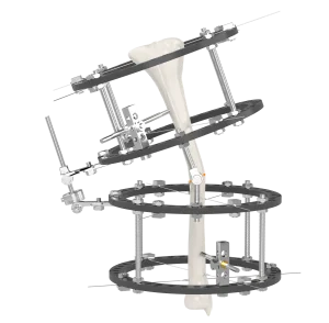 CANWELL Orthopedic Trauma Implant Ilizarov Ring Fixator External Fixator Ilizarov External Fixation