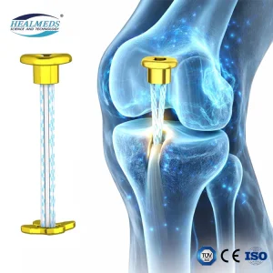 Titanium Double Loop Endobutton ACL Reconstruction
