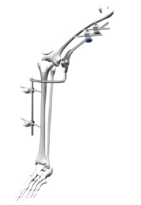 Knee External Fixator