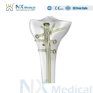 Proximal Tibial Nail