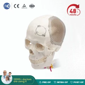 Orthopedic Cranial Implant