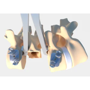 Hot-Selling New Generation Titanium Implants for Orthopedic Surgery Minimally Invasive Ready-Made Fata Combination