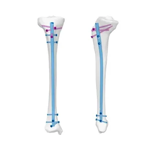 Geasure Class III Tibia Intramedullary Nail Titanium Alloy Tibial Shaft Fracture Fixation System CE Certified