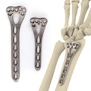 CANWELL Titanium Locking Plate Distal Radius Locking Plate Ulna Volar Variable Angel Orthopedic Implant for Fracture Surgery CE
