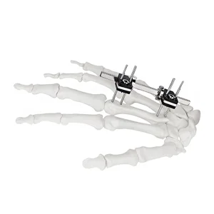 Finger External Fixator