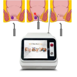 Diode Laser Hemorrhoid Surgery Device