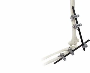 Titanium Alloy Fixator