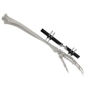 CANWELL Wrist External Fixator Small Bones Fracture Fixation Mini External Fixator Orthopedic Implant Phalanges and Metacarpals