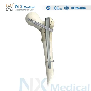 Nx Medical Pfna Bone Nail