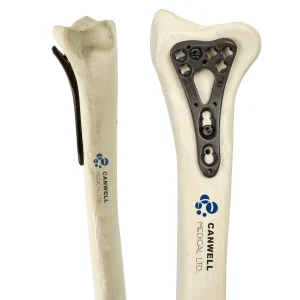 CANWELL Titanium Distal Palmar Radius Locking Plate