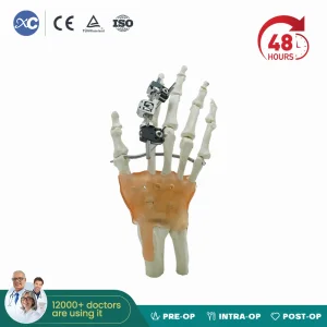 Mini Fragment External Fixator Orthopedic