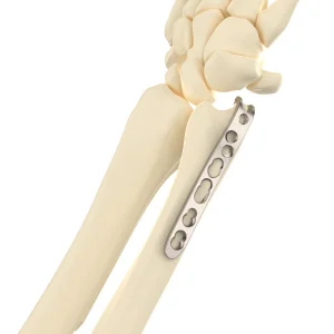 CANWELL Titanium for Distal Ulna Hook Locking Plate