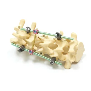 Orthopedic Implant Spinal System (Double Core and Double Thread Type)