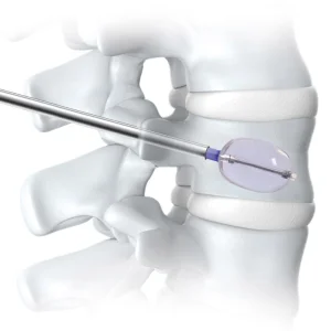 CANWELL PKP Kyphoplasty Balloon