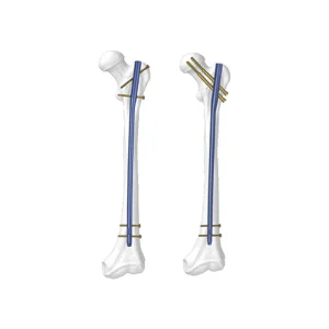 Titanium Alloy Femoral Intramedullary Nail Proximal Femoral Nailing System for Intertrochanteric Fractures