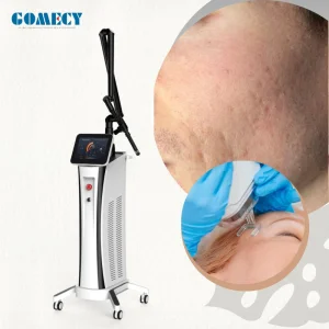 High Power Fractional CO2 Laser