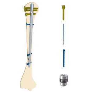 New High Quality Professional Orthopedic Implant AMH Intramedullary Nail