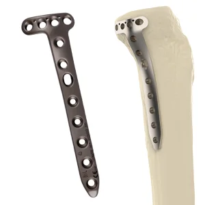 Proximal Tibial Plate