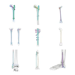 Geasure Orthopedic Implant Intramedullary Nail Trauma Fixation System Titanium Alloy CE Certified Diameter 10-11mm Length