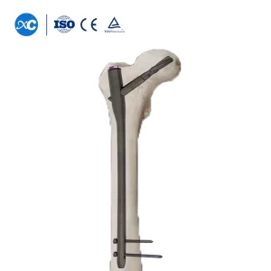 Short and Long Interlocking Screw with Saw Blades Pfna Intramedullary Instrument Set Proximal Femoral Nail Antirotation