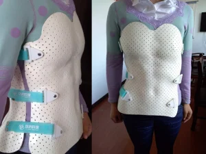 Thermoplastic Orthopedic Splint