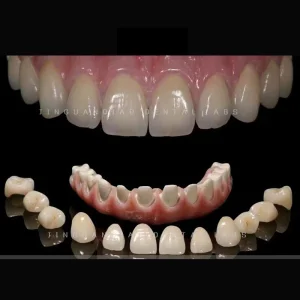 Hybrid Dentures