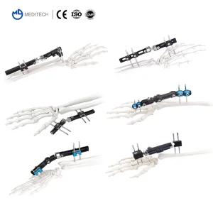 Small Fragment Fixator