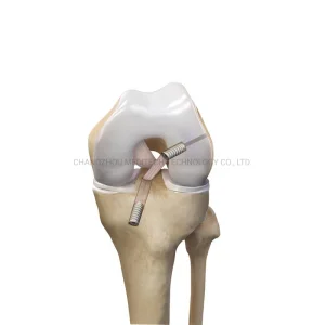 ACL Knee Reconstruction