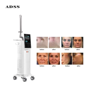 Stretch Marks CO2 Laser