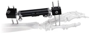 Wrist Fixator-- Unilateral Nondetachable External Fixation System