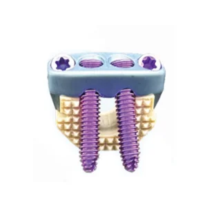 Zero Profile Anterior Cervical Cage Implants