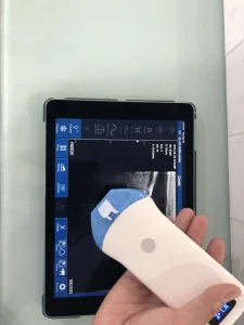 Portable Wireless Ultrasound Scanner Conevx Probe 3.5MHz Innovative Medical Device