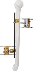 External Fixation
