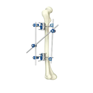 Complete Orthopedic External Fixation System Set