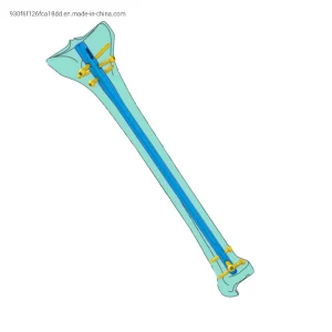Tibial Interlocking Nail Suprapatellar