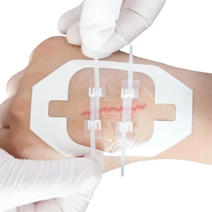 Adhesive Closure Zipper Wound Dressings