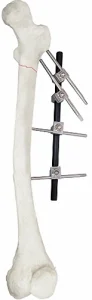 Bone Fixation