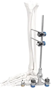 Femur Fixator Argentina