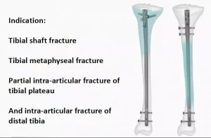 Titanium Tibia IM Nail