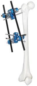 Bone Fracture Fixator