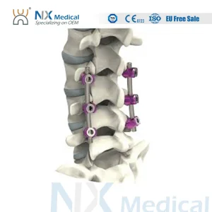 Nx Medical Spine Implant Spinal Pedicle Screw 5.5mm System Titanium OEM ODM for Fixation