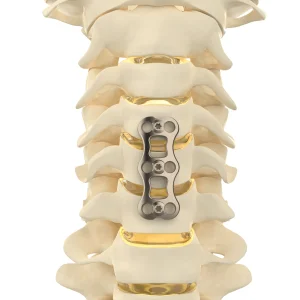 CANWELL Orthopedic Implant Spine Implant Anterior Cervical Bone Plate Cervical Spine Surgery Titanium Plate