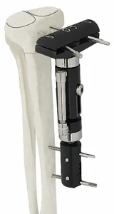 Advanced External Fixator System with Titanium Alloy for Bone Repair