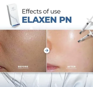 Elaxen Pn Injection