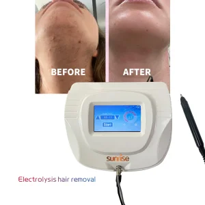 Best Price Electrolysis White Hair Removal Machine