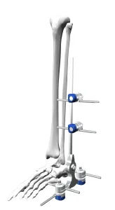 Ankle External Fixator