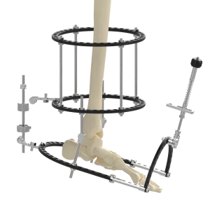 CANWELL Hybrid External Fixator Instrument Set Rod Pin Femoral Linear LRS Compact System Orthopedic CE Bone Implants Class III